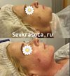 Биоревитализация