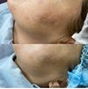 Наноперфорация кожи. Выполнен курс из 4х процедур. Улучшили качество кожи, удалили пигментацию.